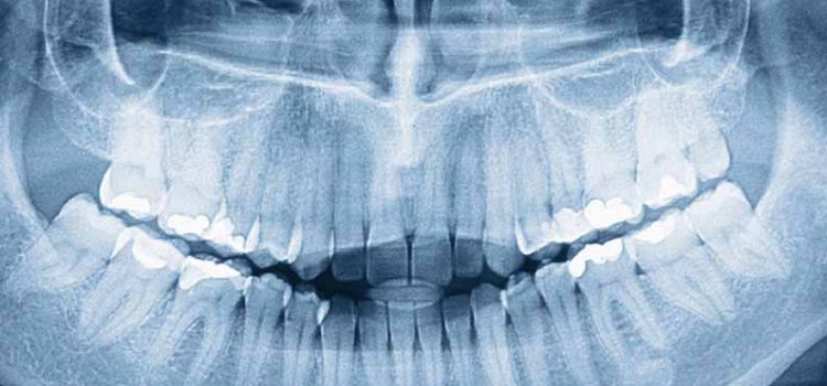 Что такое ортопантомограмма?